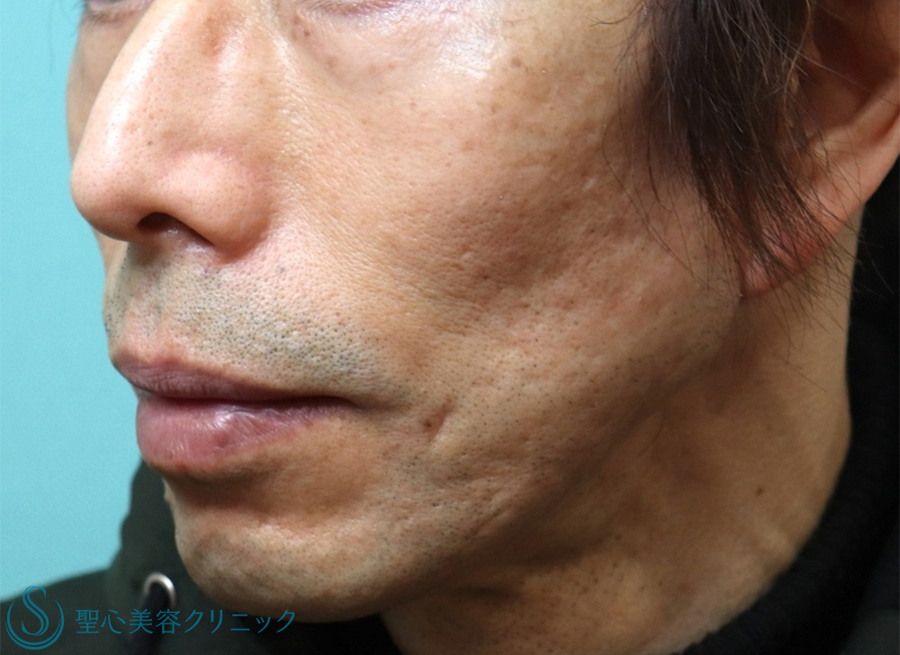 【50代男性・目の下の弛み改善】経結膜下脱脂法＋プレミアムPRP皮膚再生療法（1ヶ月後・1年後） Before 
