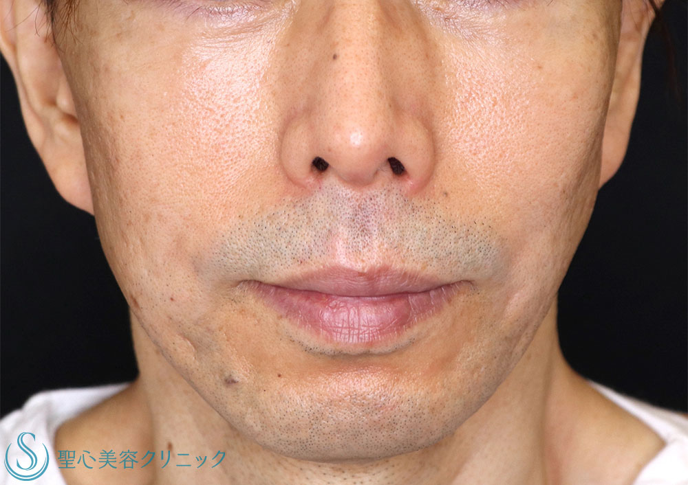 【50代男性・目の下の弛み改善】経結膜下脱脂法＋プレミアムPRP皮膚再生療法（1ヶ月後・1年後） After 