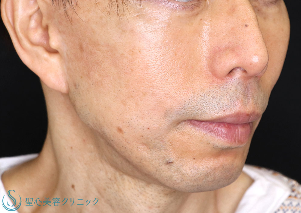 【50代男性・目の下の弛み改善】経結膜下脱脂法＋プレミアムPRP皮膚再生療法（1ヶ月後・1年後） After 