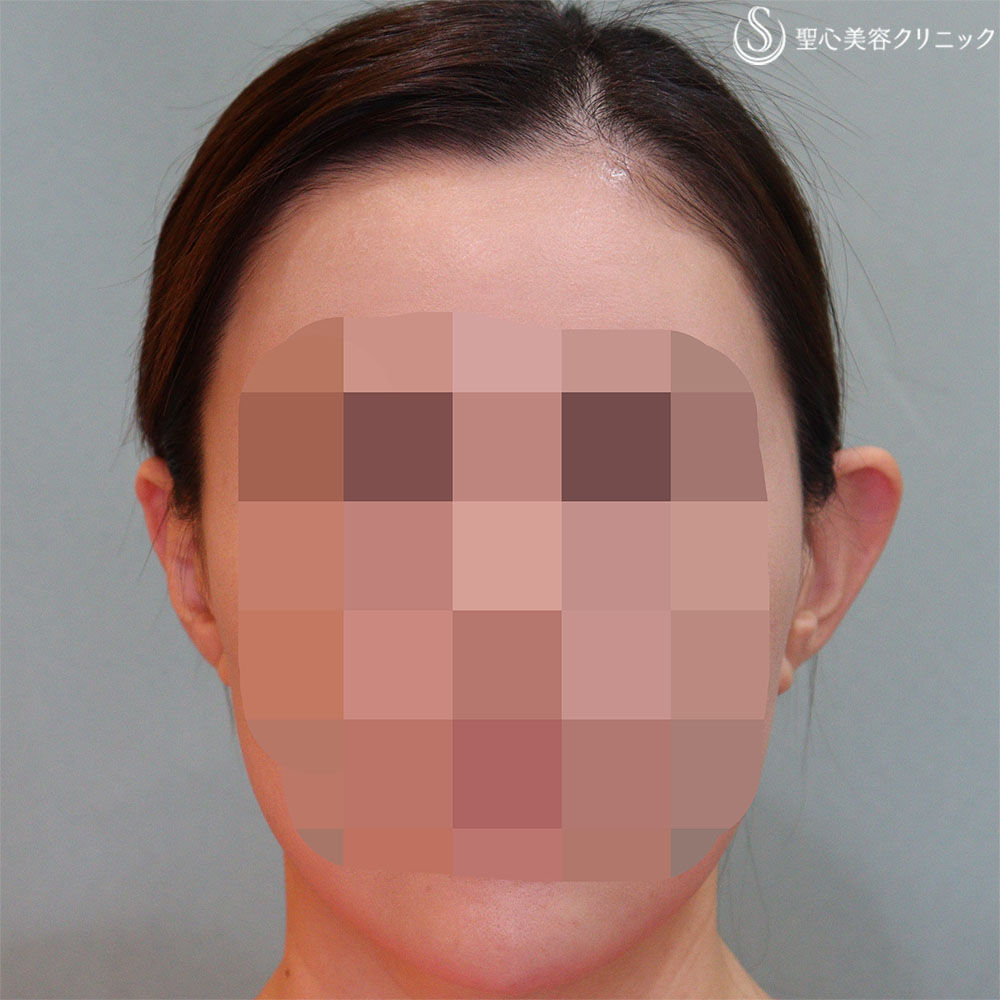 【30代女性・立ち耳の左右差を改善】立ち耳修正　埋没法（直後） Before 