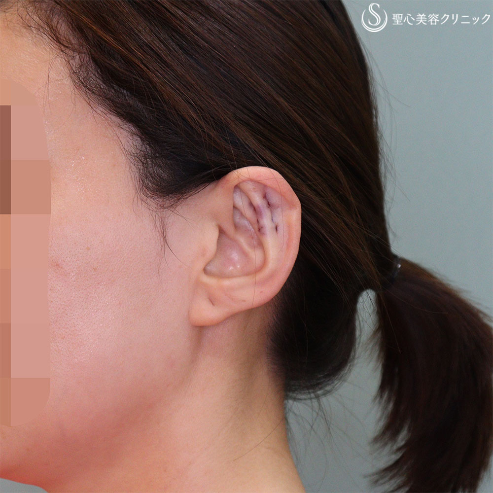 【30代女性・立ち耳の左右差を改善】立ち耳修正　埋没法（直後） After 