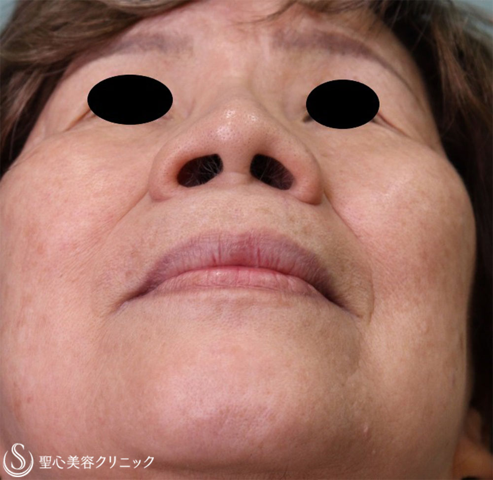 【70代女性・小鼻を小さく】小鼻縮小術（術後2か月） Before 