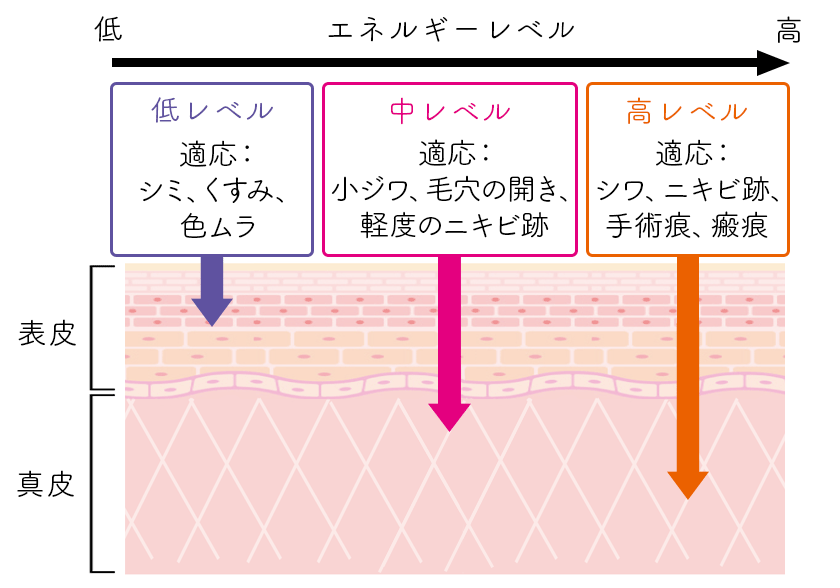 低レベル 適応：シミ、くすみ、色ムラ 中レベル 適応：小ジワ、毛穴の開き、軽度のニキビ跡 高レベル 適応：シワ、ニキビ跡、手術跡、瘢痕