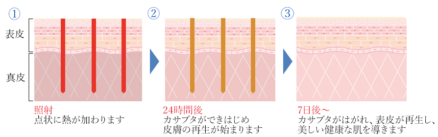 ① 照射 点状に熱が加わります ② 24時間後 カサブタができはじめ皮膚の再生が始まります ③ 7日後～ カサブタがはがれ、表皮が再生し、美しい健康な肌を導きます