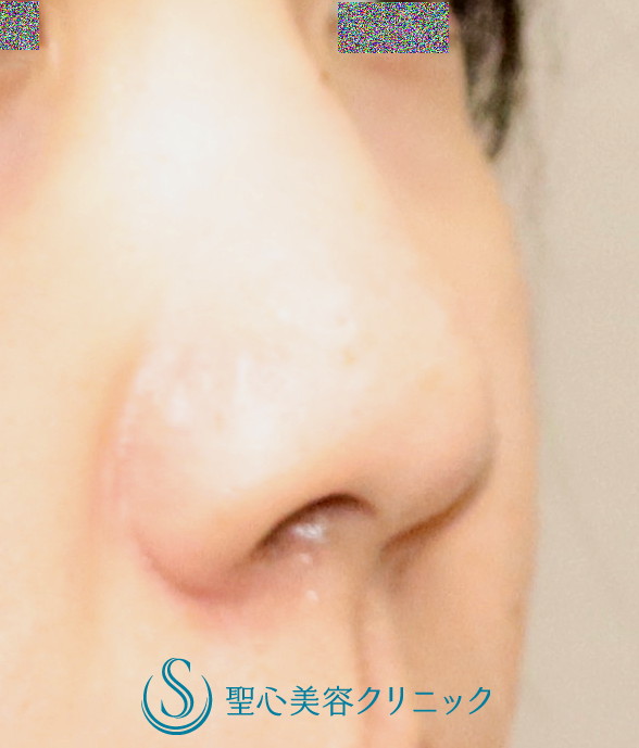 【20代女性・鼻先の丸みを改善】鼻尖縮小＋鼻尖耳介軟骨移植（1か月後） Before 