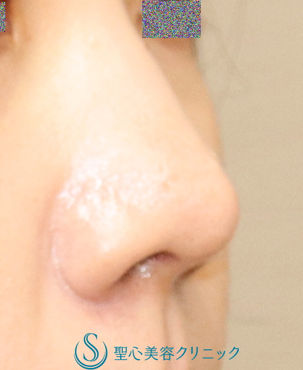 【20代女性・鼻先の丸みを改善】鼻尖縮小＋鼻尖耳介軟骨移植（1か月後） After 