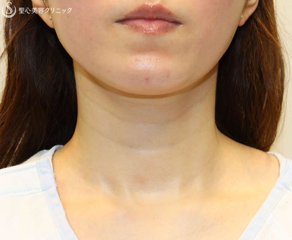 【30代女性・首のシワを解消】プレミアムPRP皮膚再生療法（3ヶ月後） Before 