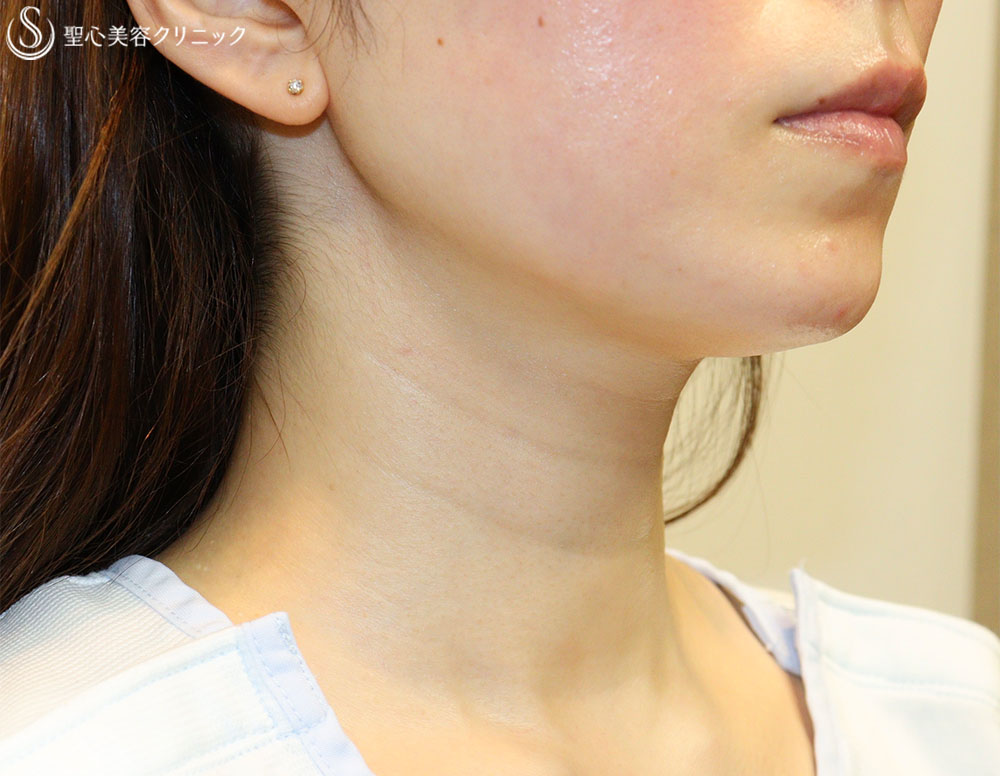 【30代女性・首のシワを解消】プレミアムPRP皮膚再生療法（3ヶ月後） Before 