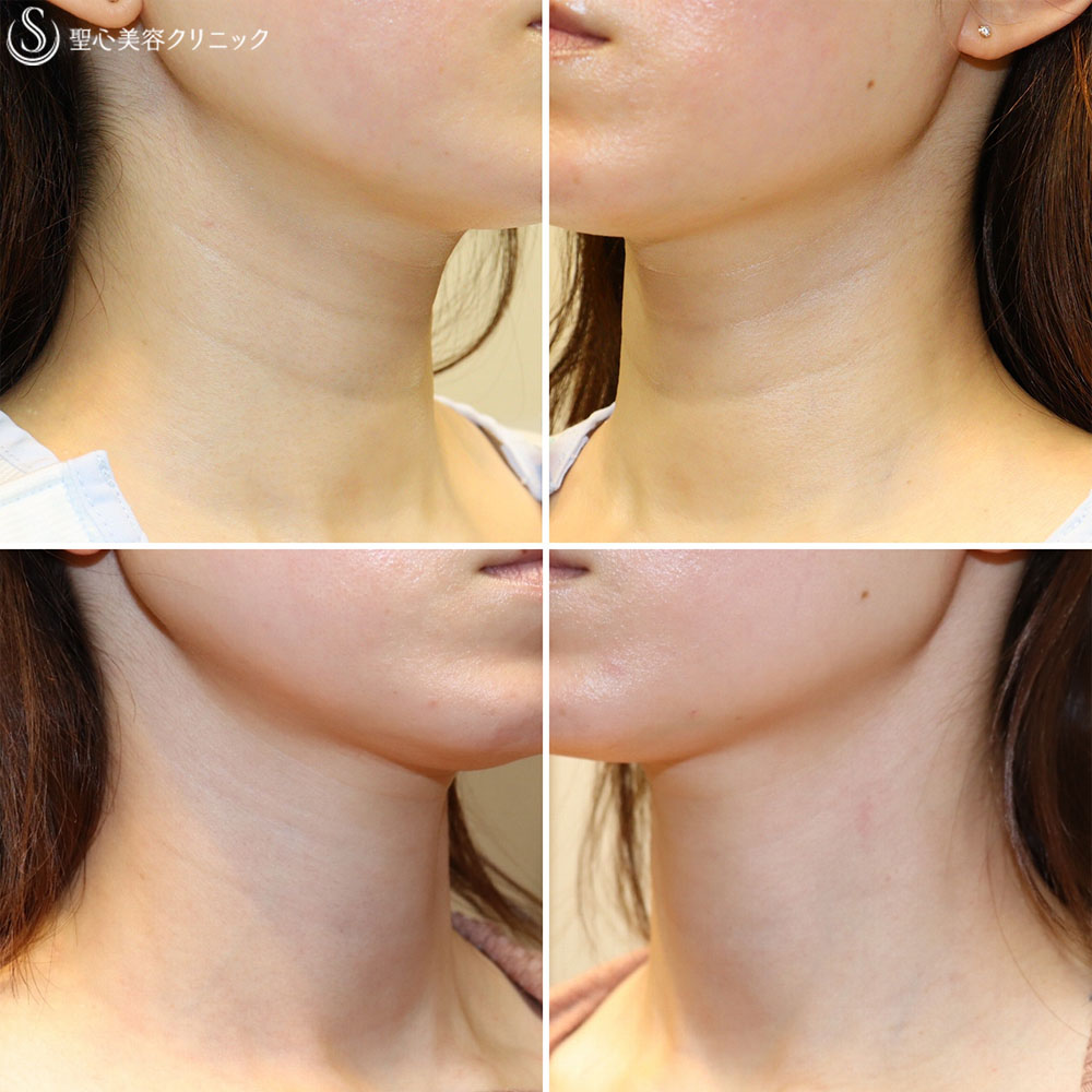 【30代女性・首のシワを解消】プレミアムPRP皮膚再生療法（3ヶ月後） After 