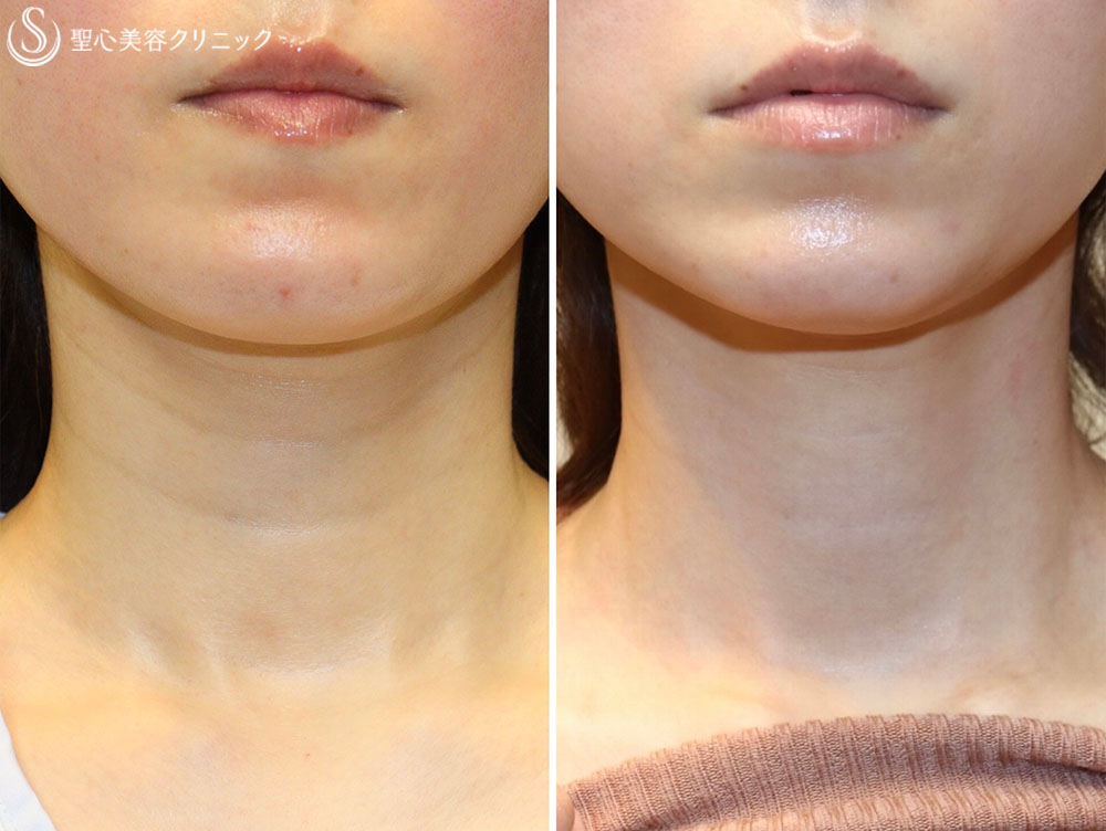 【30代女性・首のシワを解消】プレミアムPRP皮膚再生療法（3ヶ月後） After 