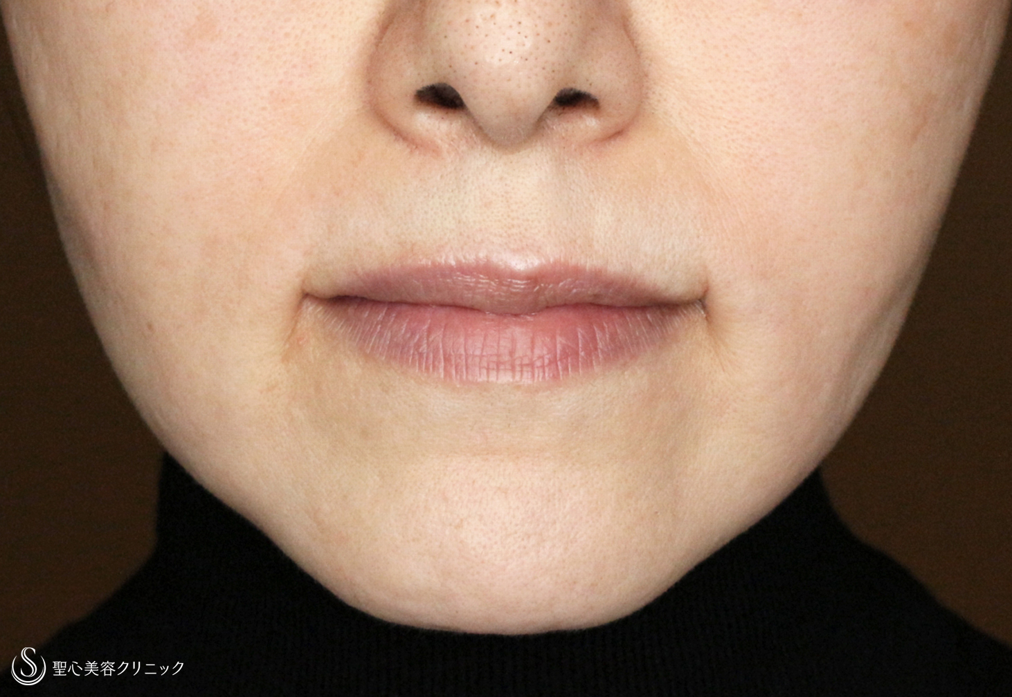 【50代女性・画期的な口角挙上の長期経過】プレミアム口角挙上で若返り（6年6ヶ月後） After 