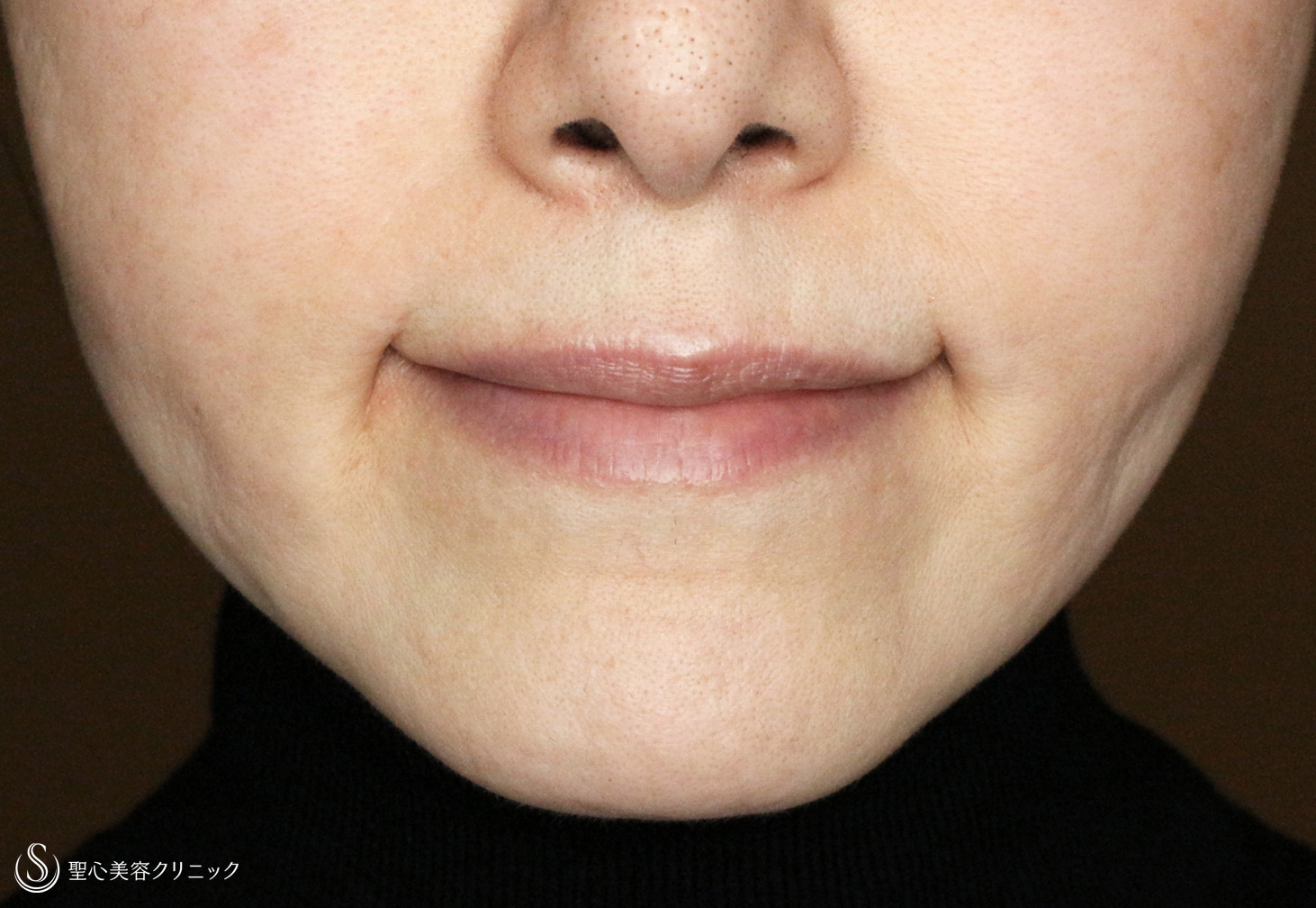 【50代女性・画期的な口角挙上の長期経過】プレミアム口角挙上で若返り（6年6ヶ月後） After 