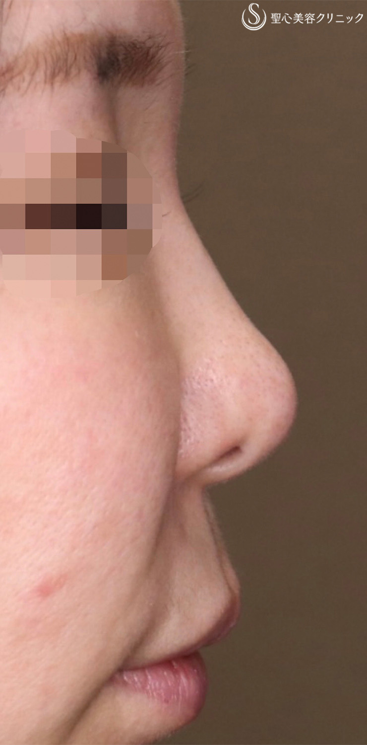 【40代女性・ナチュラルに鼻先をツンっとさせたい！！】鼻尖形成（耳介軟骨移植）（5ヶ月後） Before 