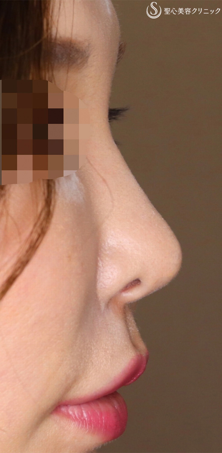 【40代女性・ナチュラルに鼻先をツンっとさせたい！！】鼻尖形成（耳介軟骨移植）（5ヶ月後） After 
