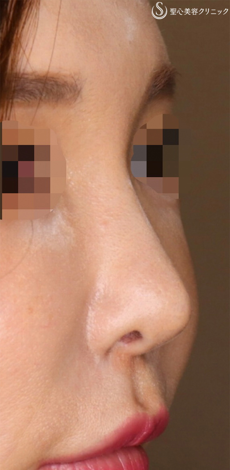 【40代女性・ナチュラルに鼻先をツンっとさせたい！！】鼻尖形成（耳介軟骨移植）（5ヶ月後） After 
