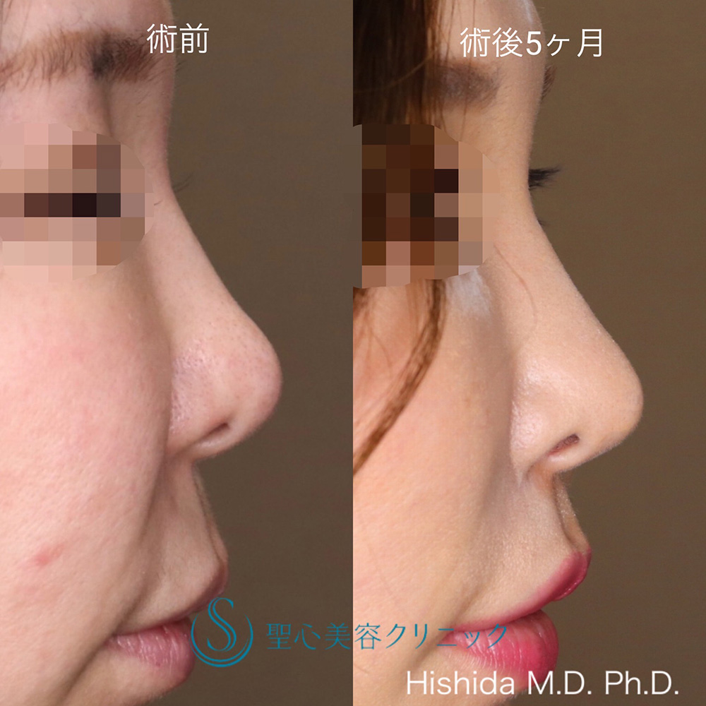 【40代女性・ナチュラルに鼻先をツンっとさせたい！！】鼻尖形成（耳介軟骨移植）（5ヶ月後） After 