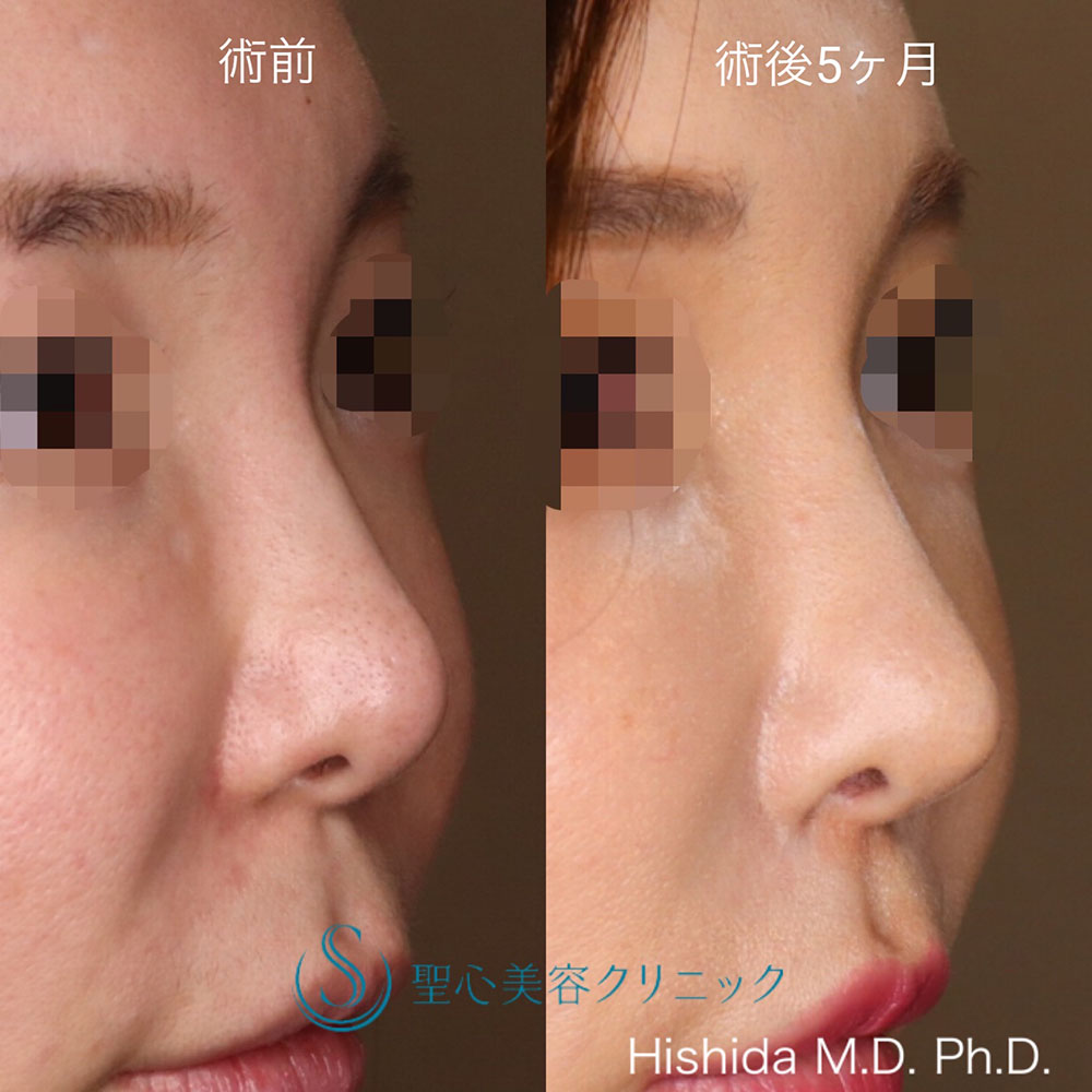 【40代女性・ナチュラルに鼻先をツンっとさせたい！！】鼻尖形成（耳介軟骨移植）（5ヶ月後） After 