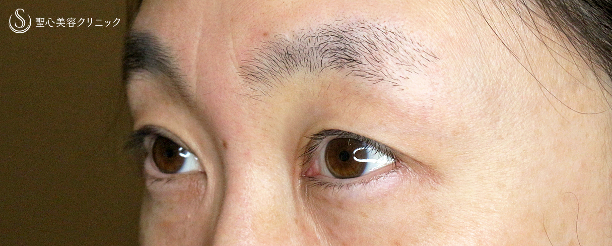 【40代女性・コンタクトレンズ下垂の第一選択】切らない眼瞼下垂+α法（2年6ヶ月後） After 