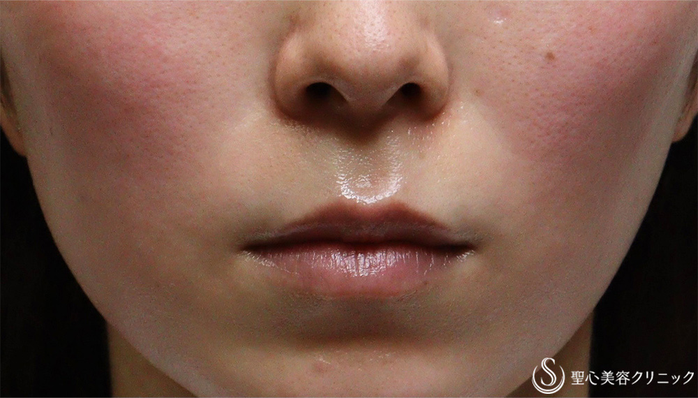 【30代女性・ほうれい線】プレミアムPRP皮膚再生療法（3ヶ月後） Before 