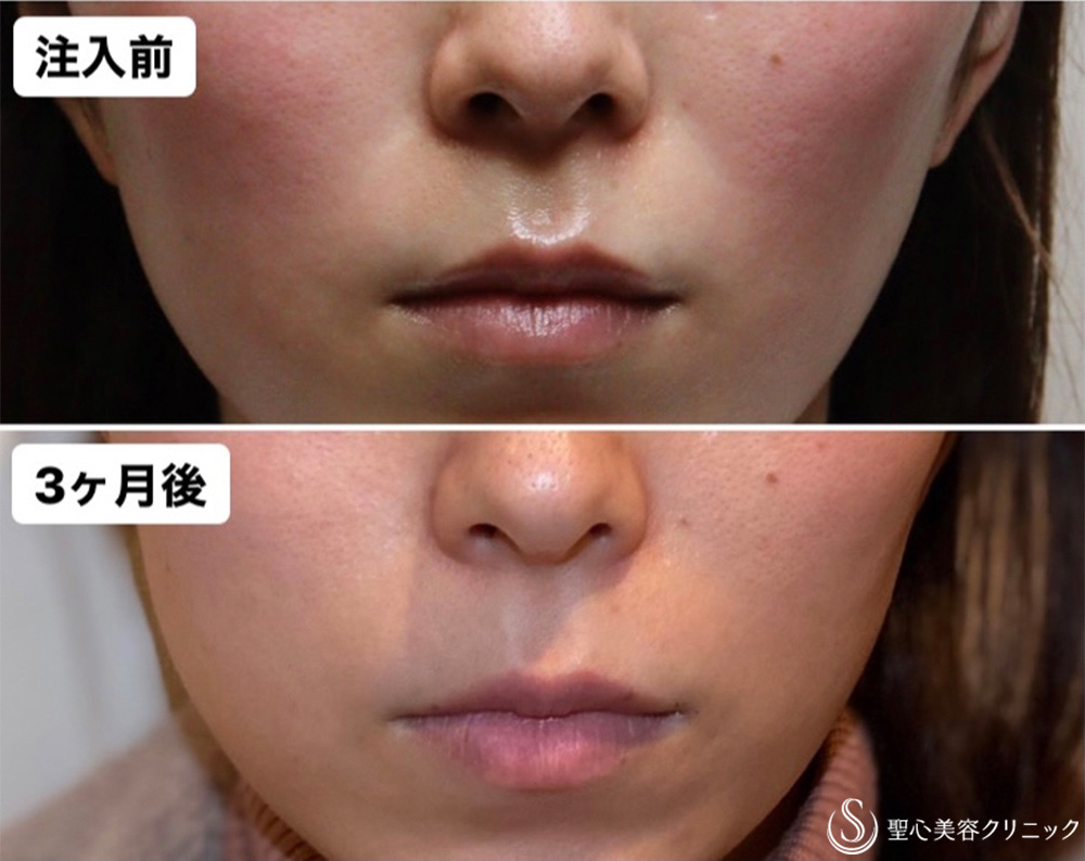 【30代女性・ほうれい線】プレミアムPRP皮膚再生療法（3ヶ月後） After 
