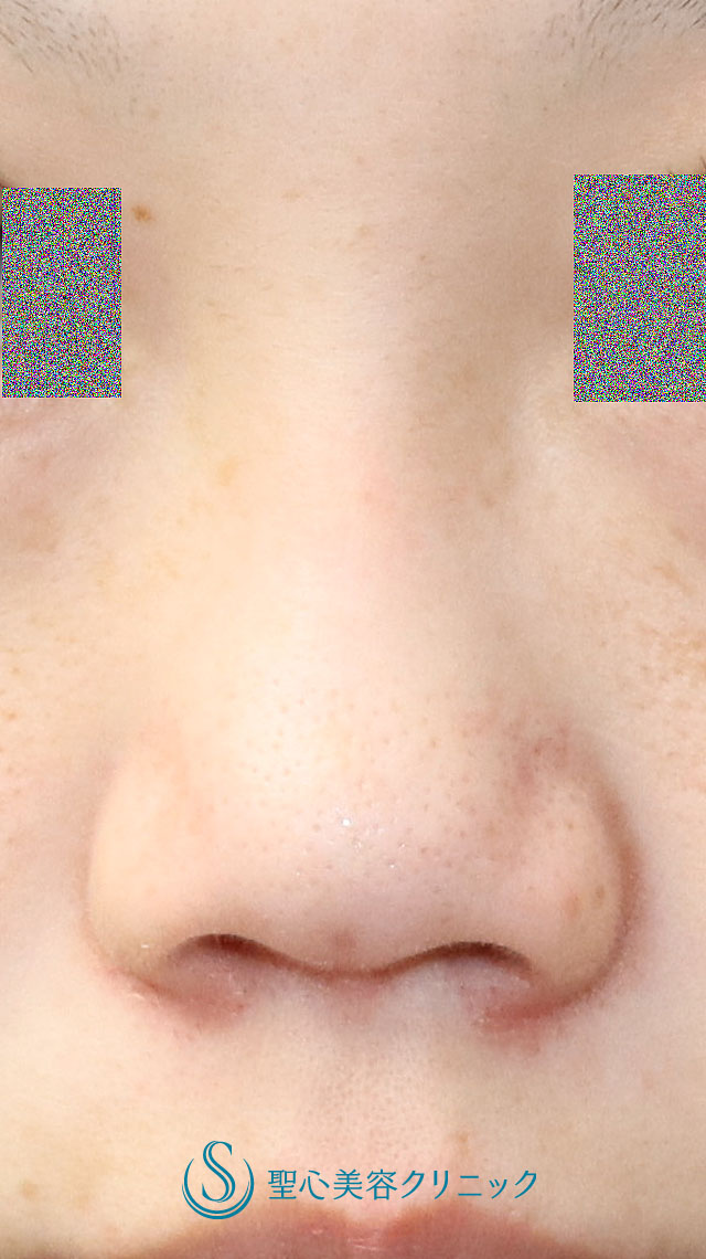 【30代女性・鼻先の丸みを細くして鼻筋を通したい】シリコンプロテーゼ（I型）による隆鼻術＋鼻尖縮小（オープン法）（術後1か月） Before 