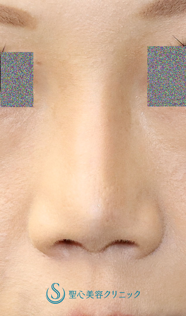 【30代女性・鼻先の丸みを細くして鼻筋を通したい】シリコンプロテーゼ（I型）による隆鼻術＋鼻尖縮小（オープン法）（術後1か月） After 