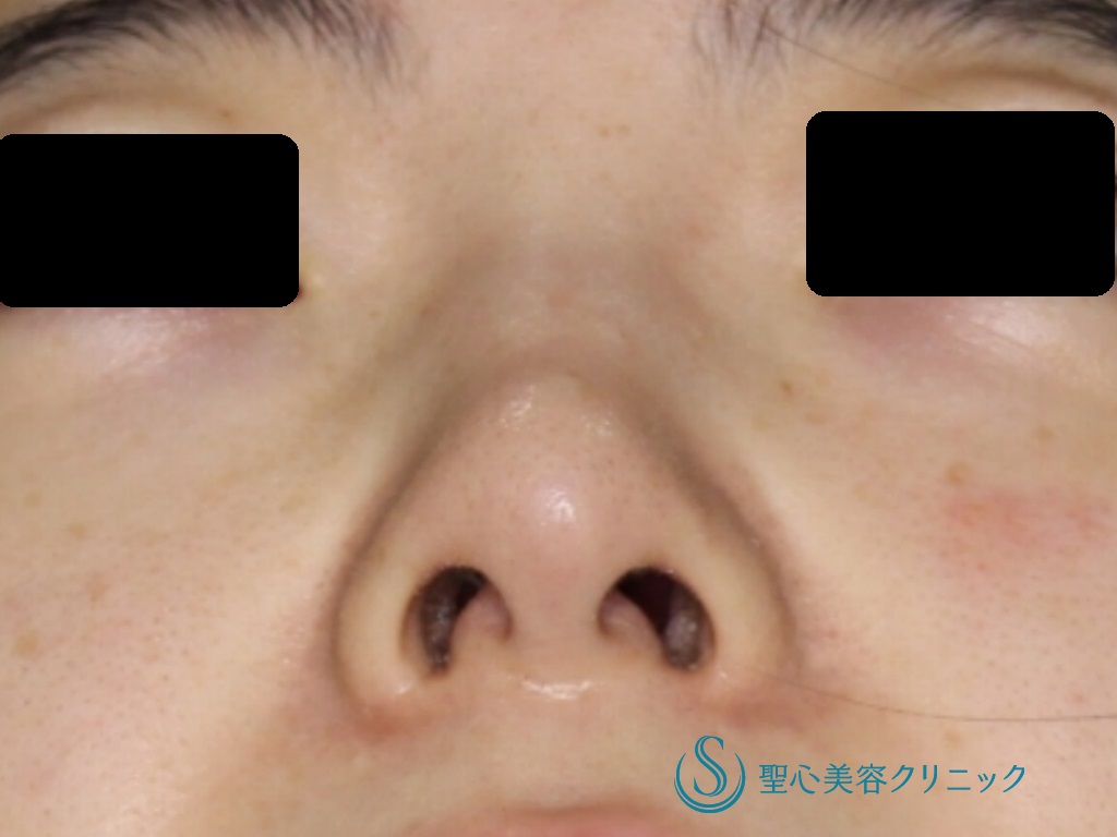 【30代女性・細くて綺麗な鼻先に！！】鼻尖縮小＋鼻尖形成（耳介軟骨移植）（術後1か月） Before 