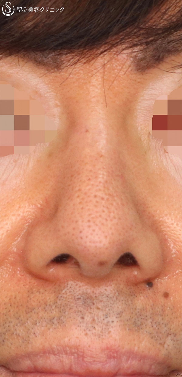 【50代男性・鼻の穴を目立ちにくく！！】鼻孔縁下降術（術後1ヶ月） Before 
