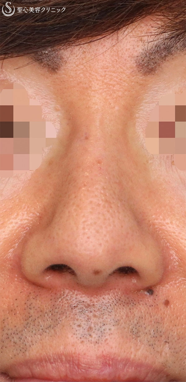 【50代男性・鼻の穴を目立ちにくく！！】鼻孔縁下降術（術後1ヶ月） After 