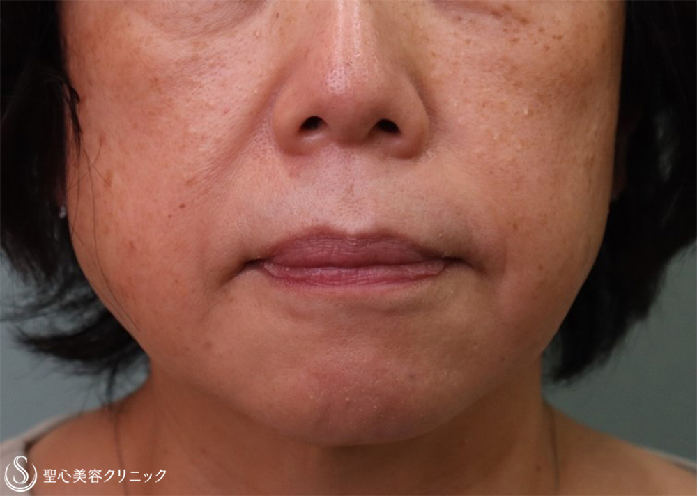 【60代女性・ほうれい線】プレミアムPRP皮膚再生療法（5か月後） Before 