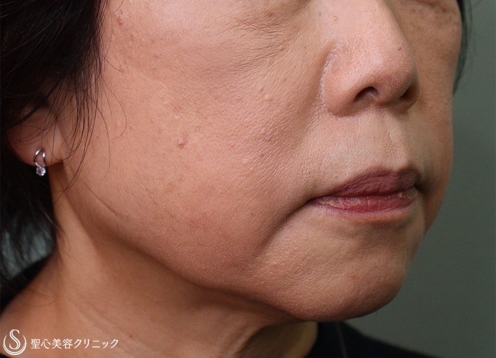【60代女性・ほうれい線】プレミアムPRP皮膚再生療法（5か月後） After 