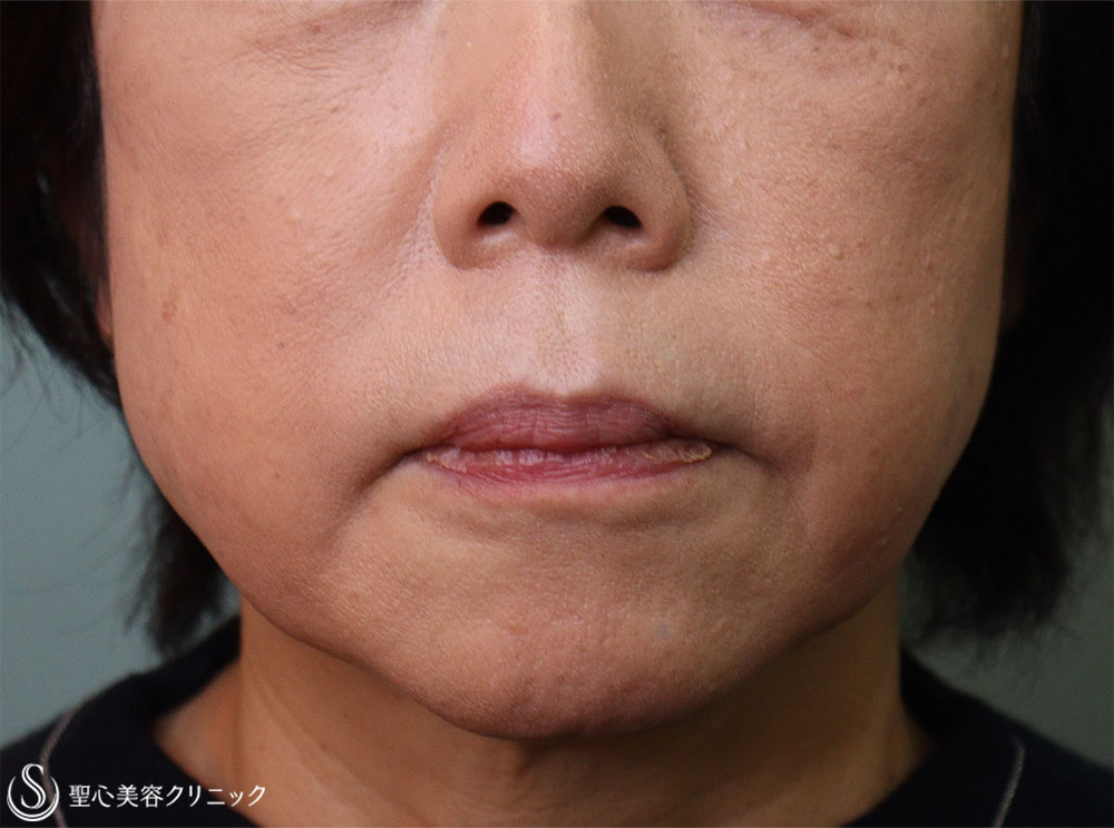 【60代女性・ほうれい線】プレミアムPRP皮膚再生療法（5か月後） After 