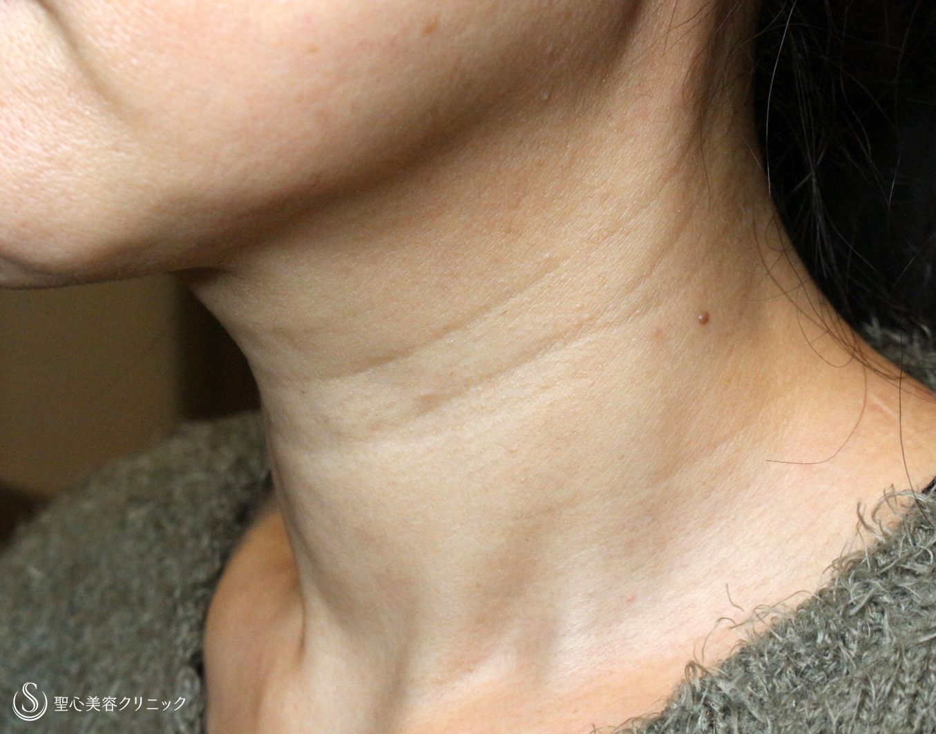 【50代女性・首の横ジワ注入治療の長期経過】プレミアムPRP皮膚再生療法（5年後） Before 