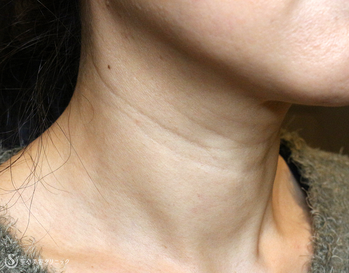 【50代女性・首の横ジワ注入治療の長期経過】プレミアムPRP皮膚再生療法（5年後） Before 