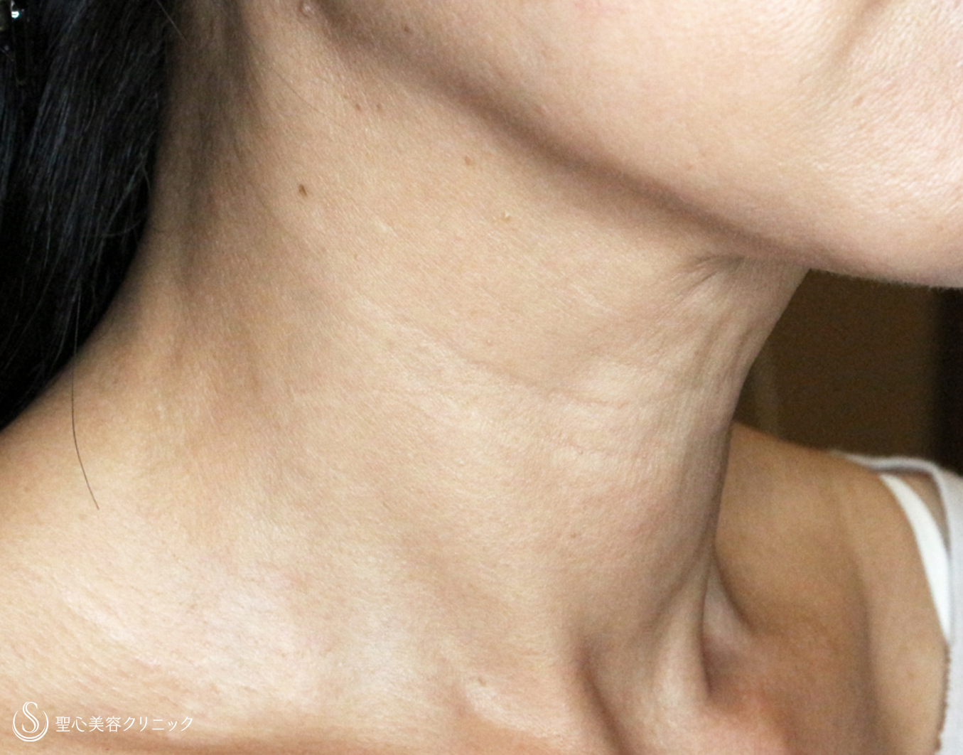 【50代女性・首の横ジワ注入治療の長期経過】プレミアムPRP皮膚再生療法（5年後） After 