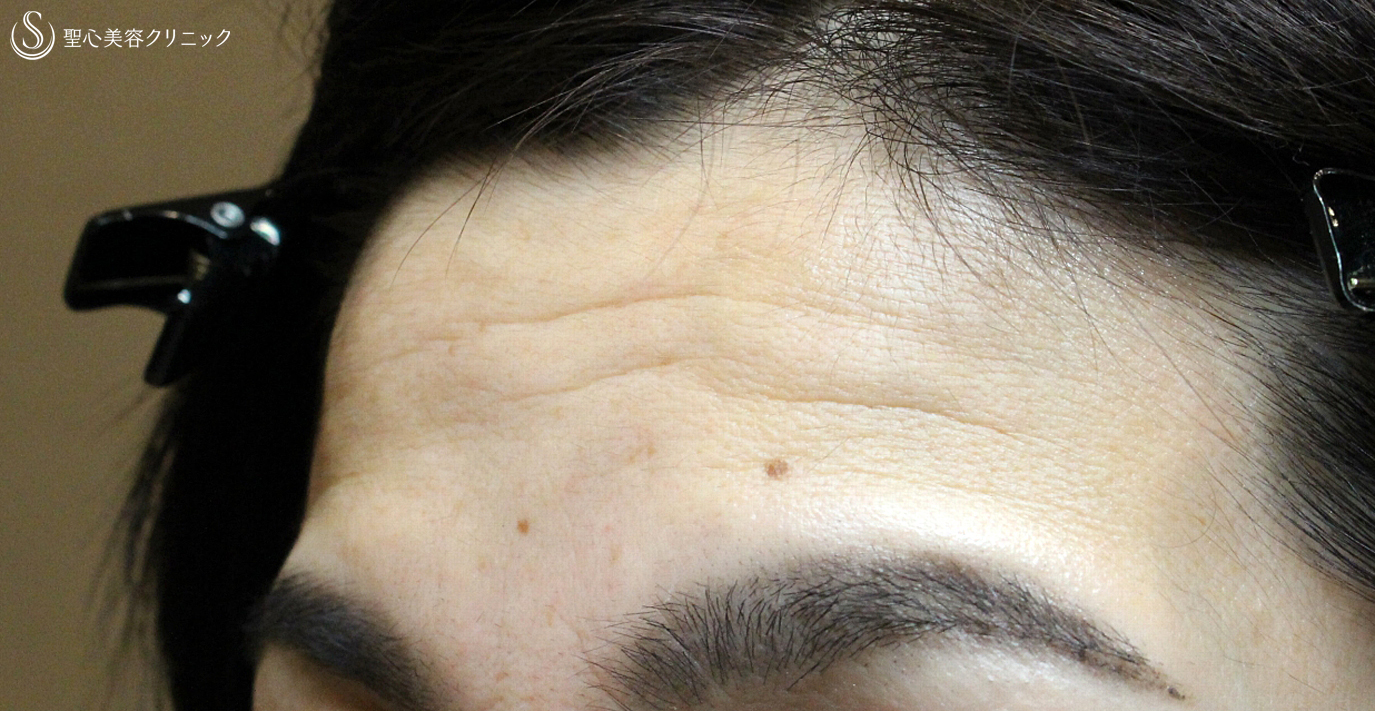 【40代女性・額のシワと凹凸を注入で長期経過】プレミアムPRP皮膚再生療法（10年後） Before 