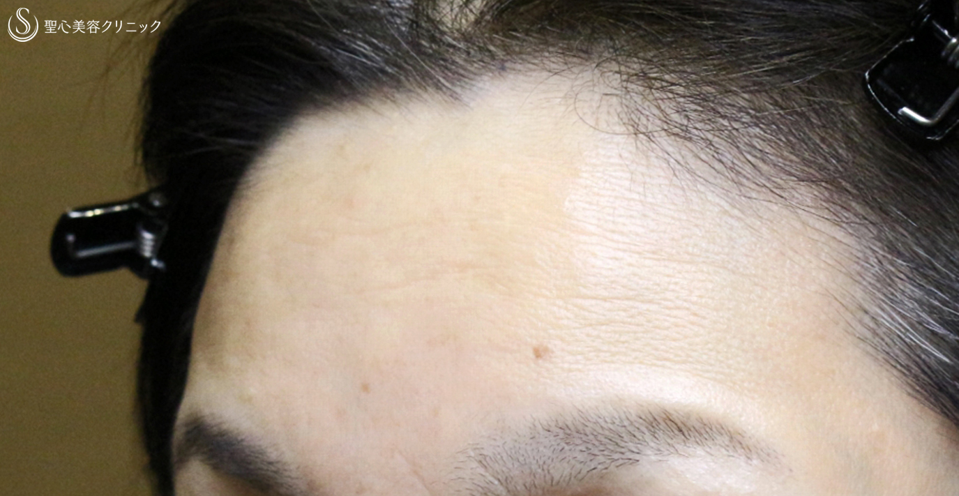 【40代女性・額のシワと凹凸を注入で長期経過】プレミアムPRP皮膚再生療法（10年後） After 