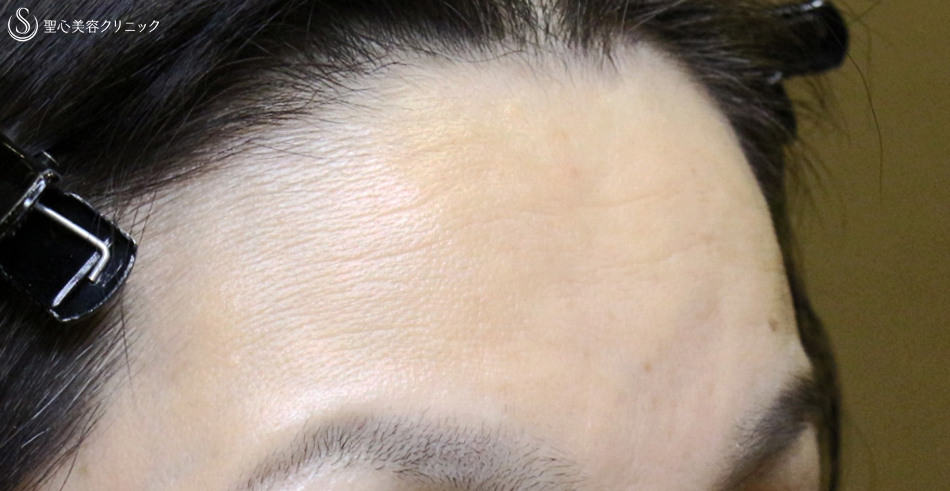 【40代女性・額のシワと凹凸を注入で長期経過】プレミアムPRP皮膚再生療法（10年後） After 
