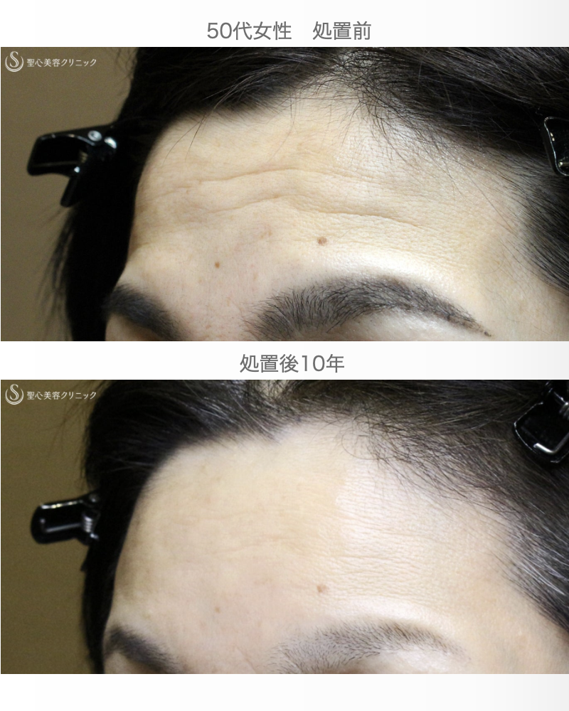【40代女性・額のシワと凹凸を注入で長期経過】プレミアムPRP皮膚再生療法（10年後） After 