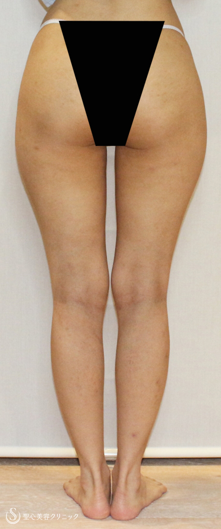 【20代女性・足を長く見せる美脚 脂肪吸引】ベイザー脂肪吸引（1ヶ月後） Before 