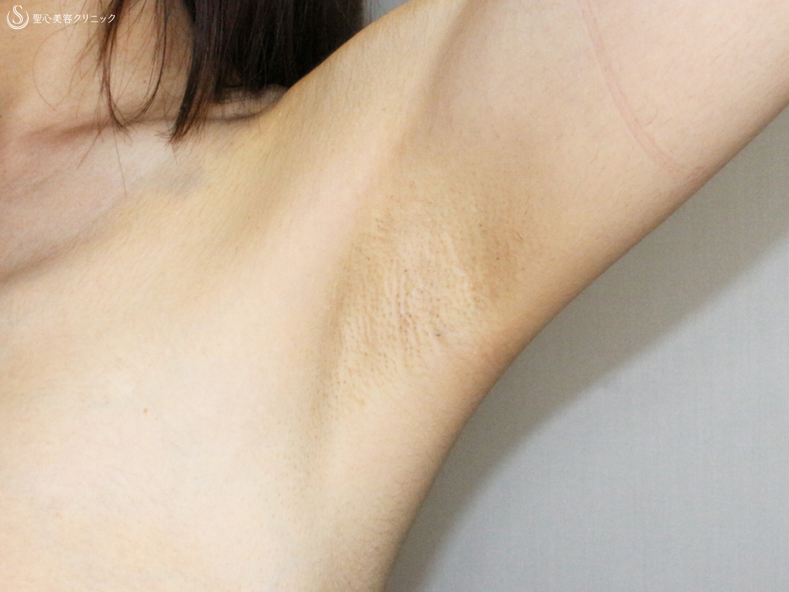 【30代女性・理想のバストをつくる】バッグプロテーゼ豊胸（6年後） After 