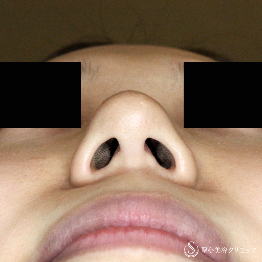 【20代女性・ダンゴ鼻の治療+α】鼻尖縮小術+α法の応用（1ヶ月後） Before 