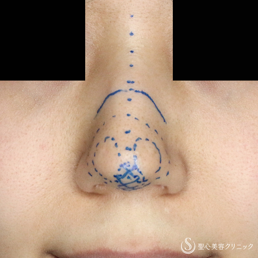 【20代女性・ダンゴ鼻の治療+α】鼻尖縮小術+α法の応用（1ヶ月後） Before 