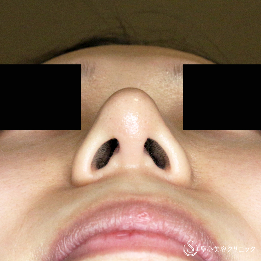 【20代女性・ダンゴ鼻の治療+α】鼻尖縮小術+α法の応用（1ヶ月後） After 