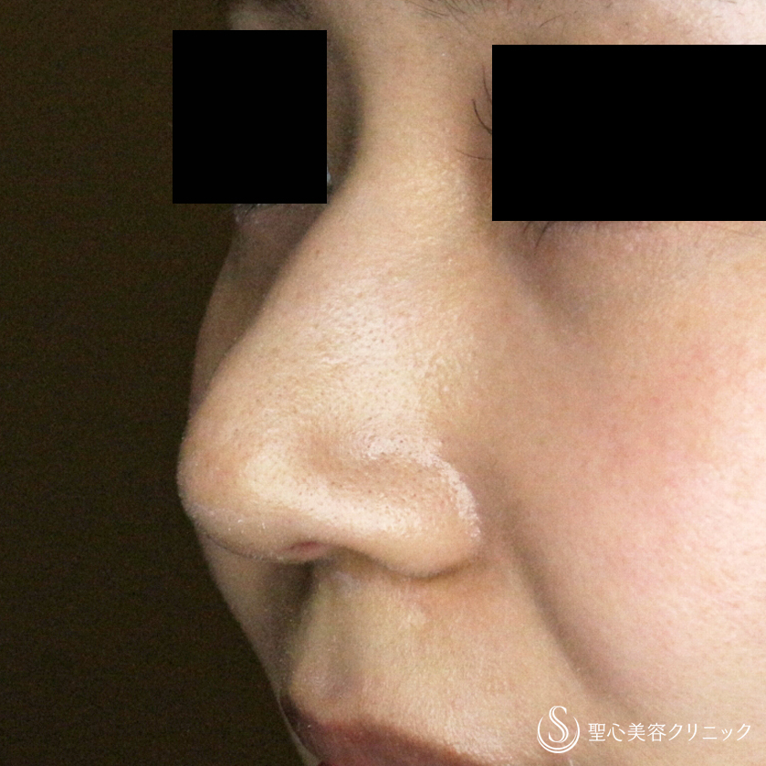 【20代女性・ダンゴ鼻の治療+α】鼻尖縮小術+α法の応用（1ヶ月後） After 