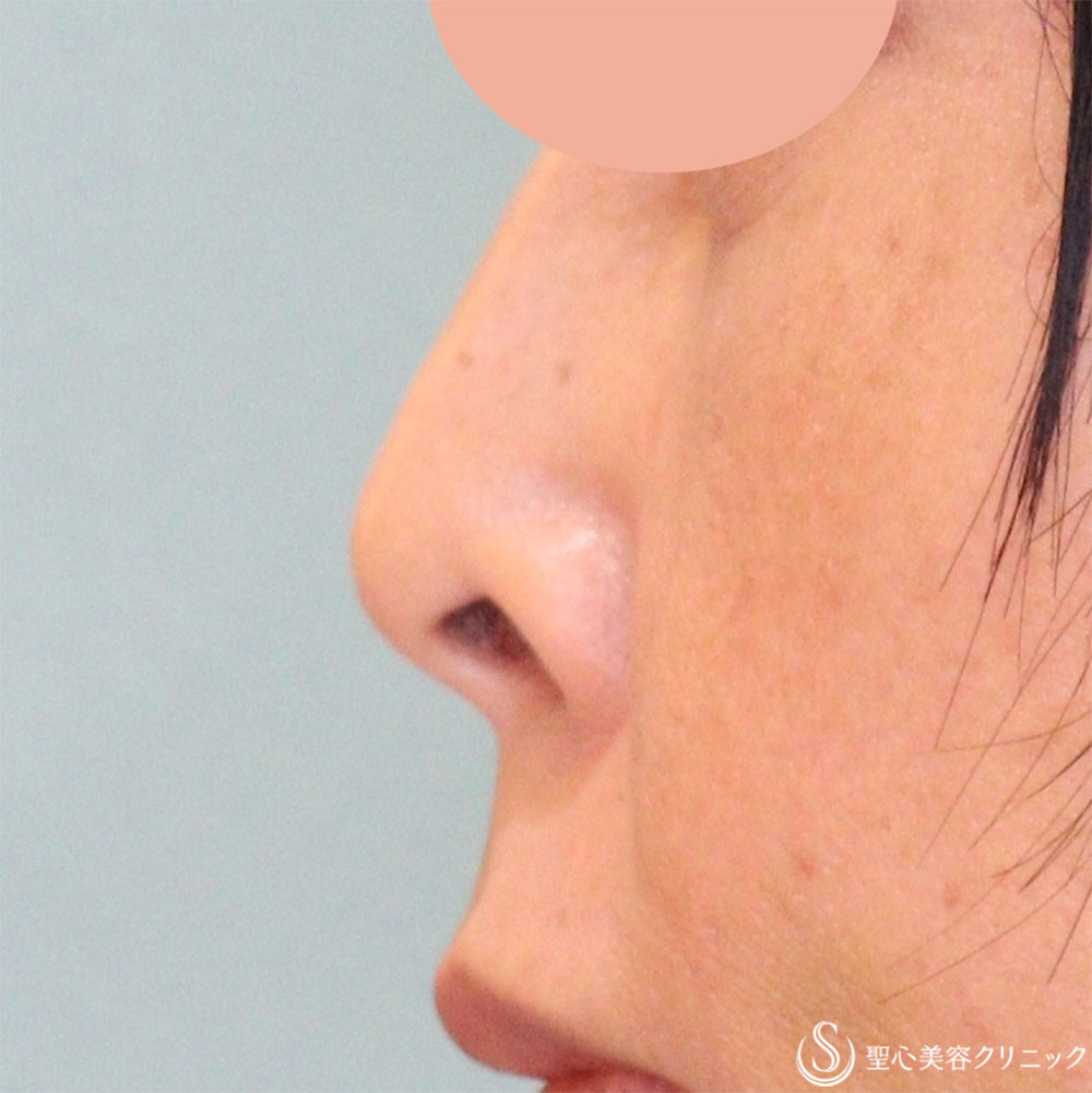 【50代女性・目立たない鼻の穴に】鼻孔縁下降術（1週間後） Before 