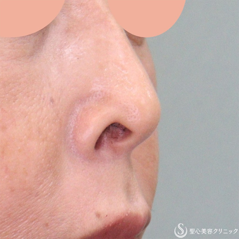 【50代女性・目立たない鼻の穴に】鼻孔縁下降術（1週間後） Before 