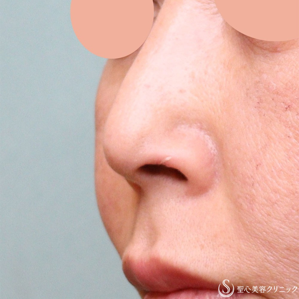 【50代女性・目立たない鼻の穴に】鼻孔縁下降術（1週間後） After 
