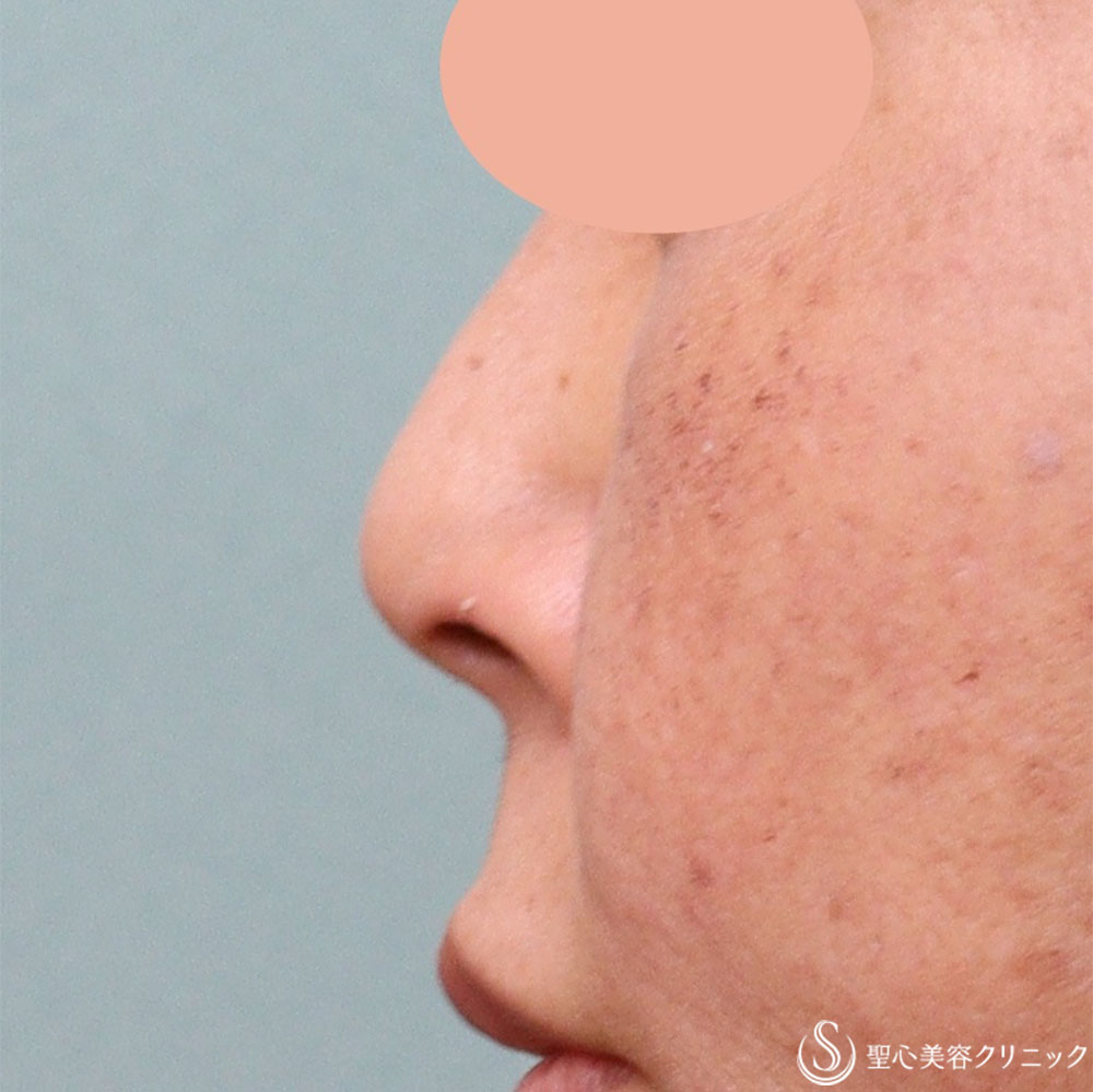 【50代女性・目立たない鼻の穴に】鼻孔縁下降術（1週間後） After 