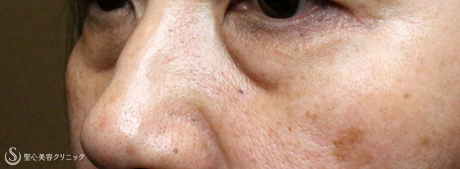 【60代女性・目の下のクマを注入治療だけで】プレミアムPRP皮膚再生療法（7ヶ月後） Before 